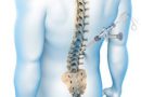 PHẪU THUẬT NỘI SOI CỘT SỐNG ( Endoscopic spine surgery: ESS)