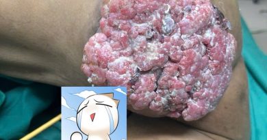 NỖ LỰC CỨU SỐNG BỆNH NHÂN U MÔNG XUẤT HUYẾT NẶNG TẠI BỆNH VIỆN C ĐÀ NẴNG NỖ LỰC CỨU SỐNG BỆNH NHÂN U MÔNG XUẤT HUYẾT NẶNG TẠI BỆNH VIỆN C ĐÀ NẴNG