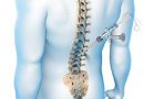 PHẪU THUẬT NỘI SOI CỘT SỐNG (Endoscopic spine surgery: ESS) (Kỹ thuật xâm lấn tối thiểu, hiệu quả tối đa)