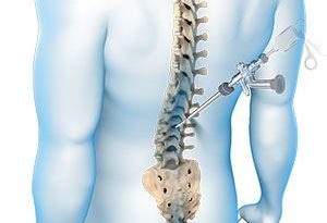 PHẪU THUẬT NỘI SOI CỘT SỐNG (Endoscopic spine surgery: ESS) (Kỹ thuật xâm lấn tối thiểu, hiệu quả tối đa)