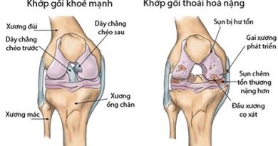 VAI TRÒ CỦA Y HỌC CỔ TRUYỀN TRONG ĐIỀU TRỊ  THOÁI HÓA KHỚP Ở NGƯỜI CAO TUỔI